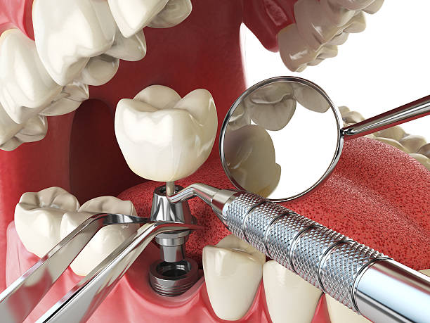 Best Root Canal Emergency Dentist  in Richland, GA